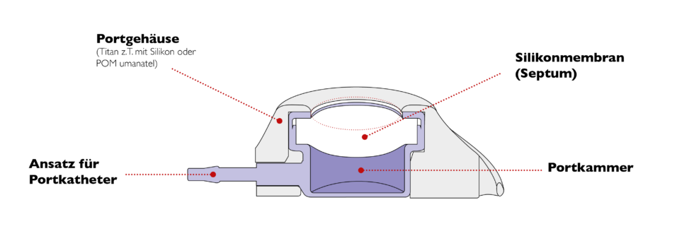 Portkatheter und Portkanülen - Vygon