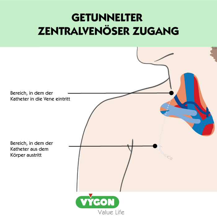 Getunnelter-zentralvenöser-Zugang