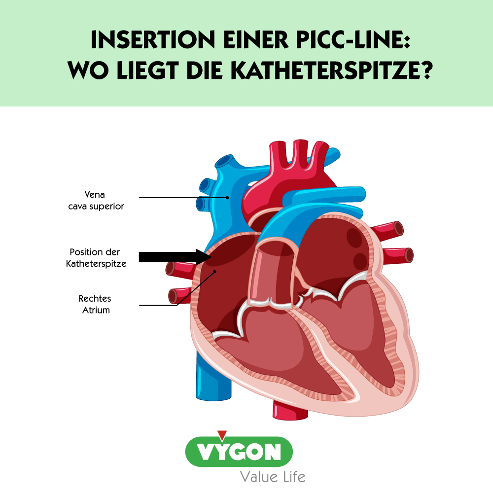 Insertion-einer-PICC-line--Wo-liegt-die-Katheterspitze-