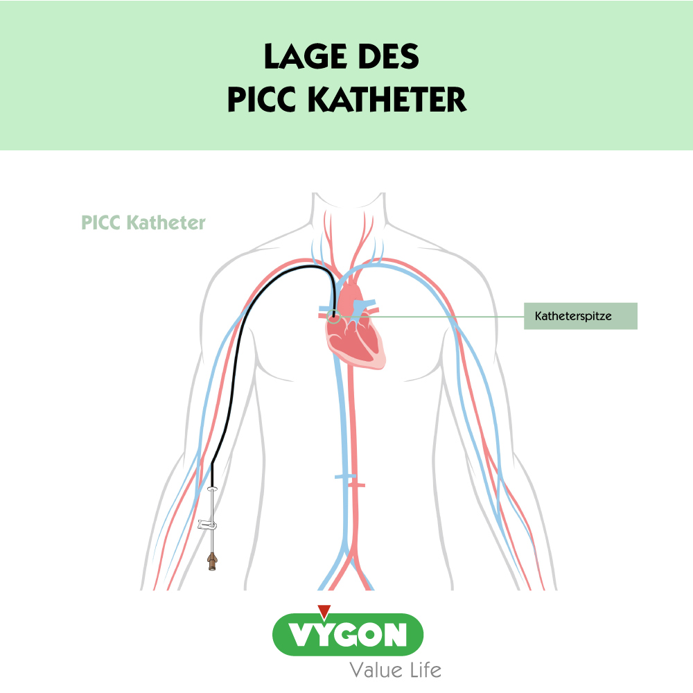 PICC-Katheter-Positionierung-1