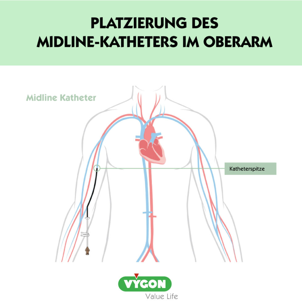 PICC-Peripher eingeführter Zentralkatheter -Die wichtigsten Fakten