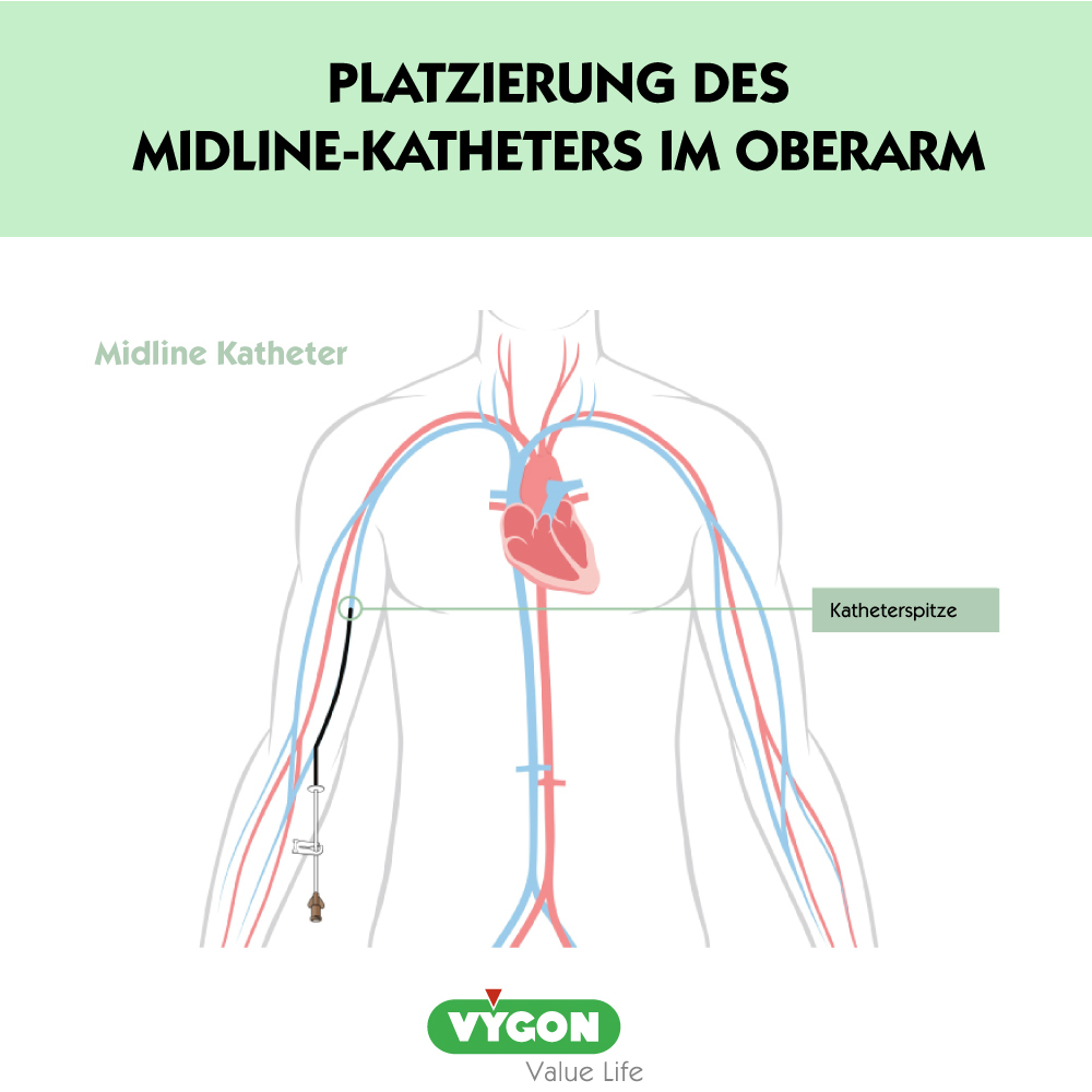 Platzierung-des-midline-am-oberarm-1