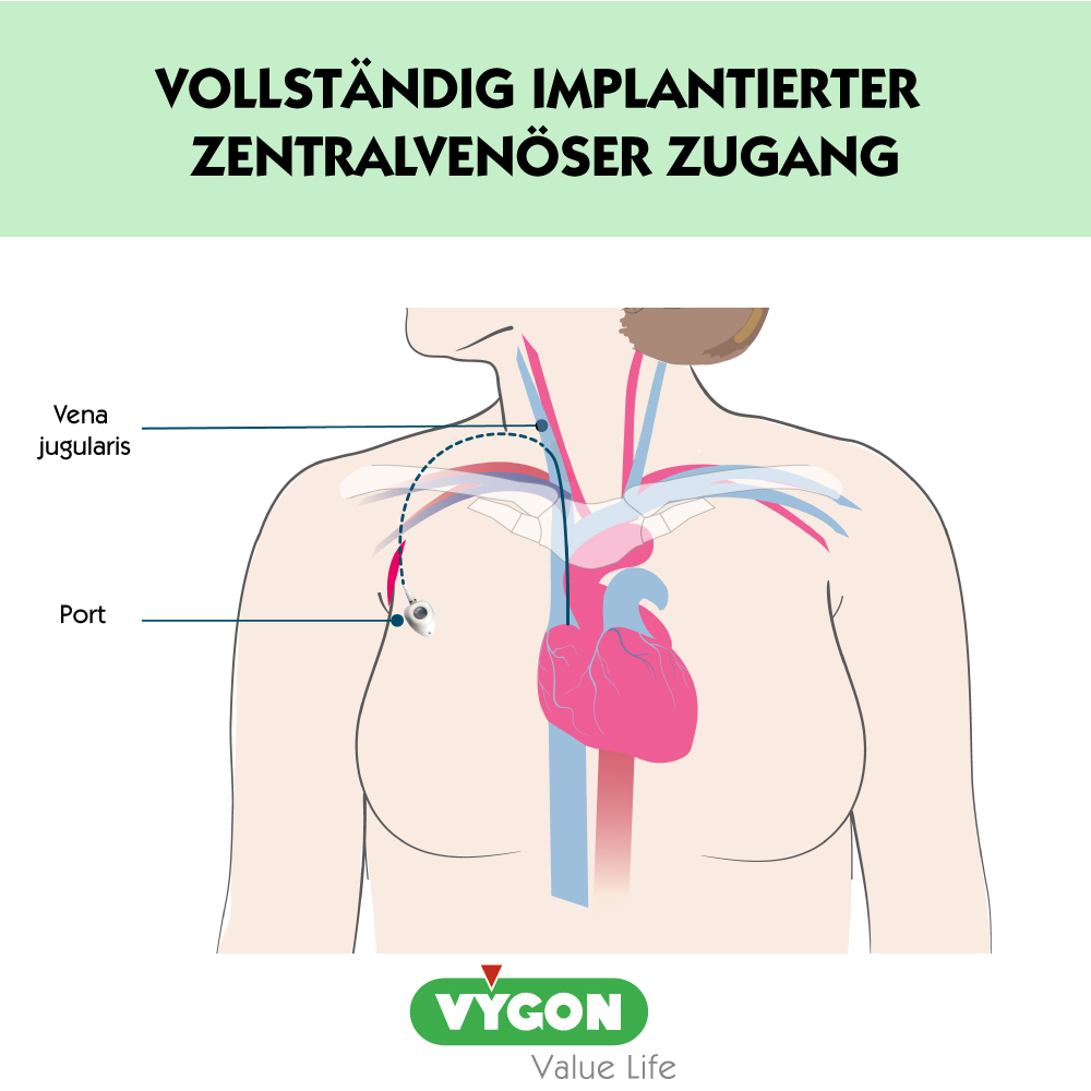 Vollständig-implantierter-zentralvenöser-Zugang