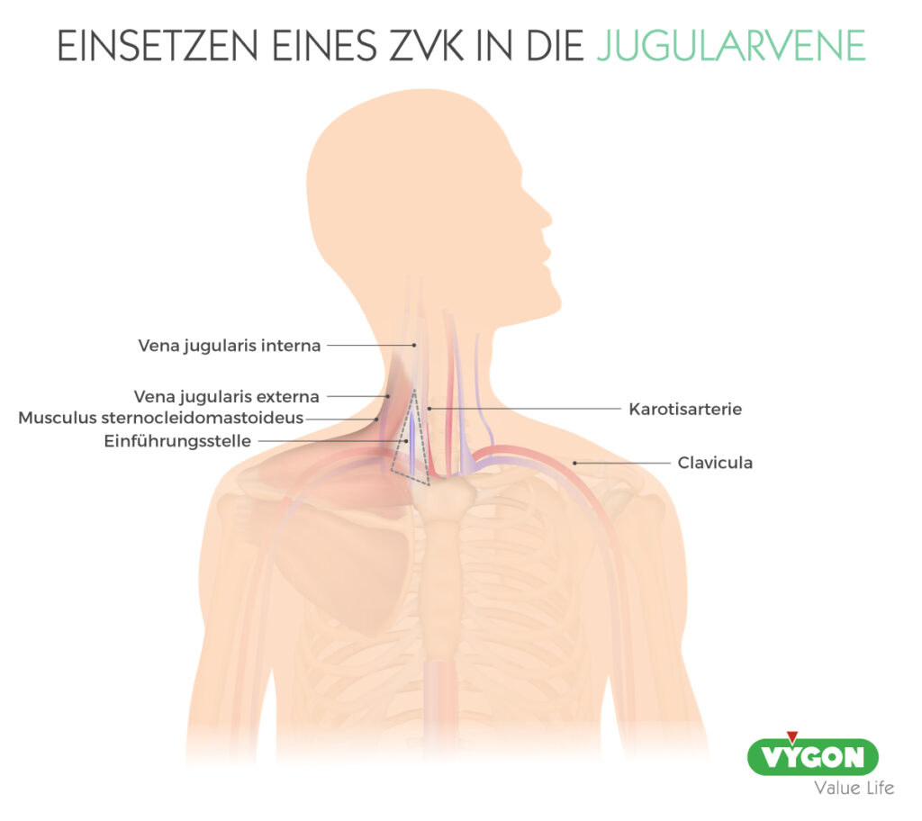 Bild02_EINSETZEN-EINES-ZVK-IN-DIE-JUGULARVENE