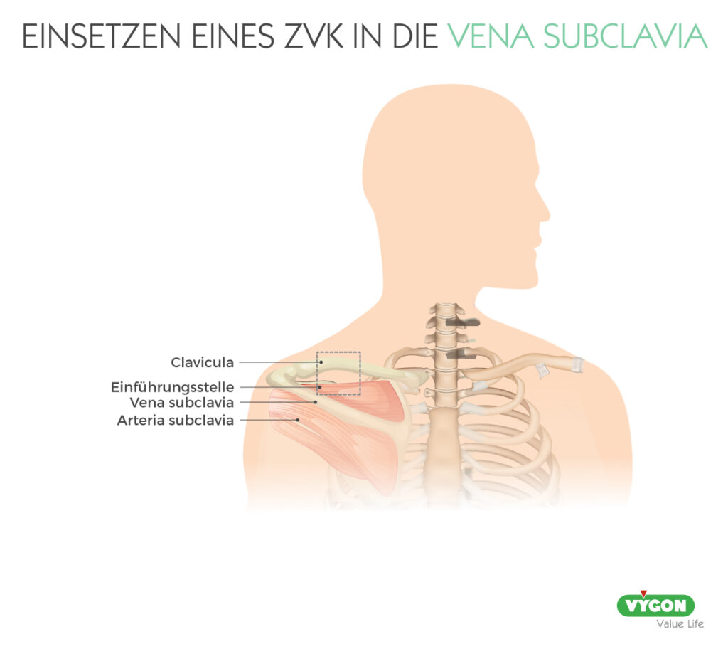 Bild04_EINSETZEN-EINES-ZVK-IN-DIE-VENA-SUBCLAVIA