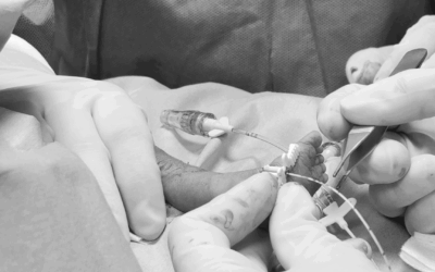 Die klinische Relevanz der modifizierten Seldinger-Technik (MST) in der Neonatologie